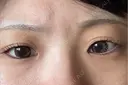 目頭切開 Stand by Beauty Clinic BEFORE サムネイル用