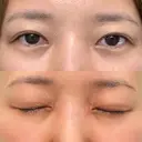 眼瞼下垂（切開） / 下まぶたたるみ取り WOM CLINIC GINZA （ワム クリニック ギンザ） BEFORE サムネイル用