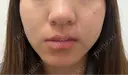 ピコレーザートーニング（美白・肝斑） / フラクショナルレーザー（毛穴・ニキビ跡） ルラ美容クリニック 京都院 BEFORE サムネイル用