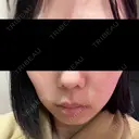光治療（フォトフェイシャルなど） トラスト美容クリニック 銀座院 BEFORE サムネイル用
