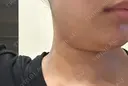 インモード 名古屋美容外科 BEFORE サムネイル用