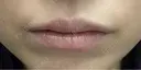 ヒアルロン酸注入（唇） / ボトックス（口角） 目白ホワイトクリニック BEFORE サムネイル用