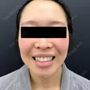 糸リフト / メーラーファット除去 / ジョールファット除去 BLINC CLINIC （ブリンク クリニック） BEFORE サムネイル用