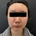 糸リフト / ジョールファット除去 BLINC CLINIC （ブリンク クリニック） BEFORE サムネイル用