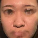 鼻尖形成（切開） / 小鼻縮小（切開） / ワシ鼻修正・ハンプ切除 / 鼻修正 / 鼻尖縮小 / 真皮移植 LUHO（ルホ）美容外科 BEFORE サムネイル用