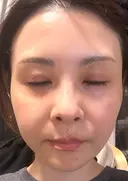 肌育注射（ジュベルックなど） / その他（肌） けやき美容クリニック 沼津院 BEFORE サムネイル用
