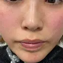 ピーリング（ハリ・ツヤ） HAAB CLINIC 池袋院 BEFORE サムネイル用