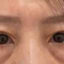 クマ治療 / 脂肪注入（額） / 脂肪注入（目の下） eクリニック 福岡院 BEFORE サムネイル用