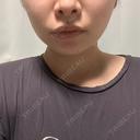 バッカルファット除去 / 脂肪吸引（顔） / あご下筋肉縛り セギム美容整形外科 BEFORE サムネイル用