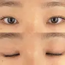 二重埋没 恵聖会クリニック 京橋院 BEFORE サムネイル用