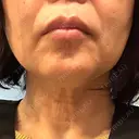 オリジオ ゆきスキンクリニック 東池袋 BEFORE サムネイル用