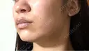 ポテンツァ 日比谷セントラルクリニック BEFORE サムネイル用