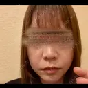 ほくろ・いぼ除去レーザー（肌） / ピコスポット Fellez Clinic【フェルズクリニック】 BEFORE サムネイル用