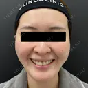 糸リフト / 脂肪吸引（顔） / メーラーファット除去 / ジョールファット除去 BLINC CLINIC （ブリンク クリニック） BEFORE サムネイル用
