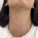 RF（高周波）たるみ治療 / インモード 東京美容皮膚科アロエクリニック池袋 BEFORE サムネイル用