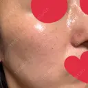 美肌レーザー / ピコレーザートーニング（美白・かんぱん） LE CLINIC BEFORE サムネイル用