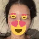 ヒアルロン酸注入（涙袋） / ヒアルロン酸注入（頬） / ヒアルロン酸注入（こめかみ） PRISM Beauty Clinic 新宿院 BEFORE サムネイル用