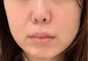 デンシティ フィラークリニック 新宿院 BEFORE サムネイル用