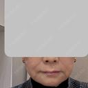 糸リフト 銀座美容外科クリニック 銀座院 BEFORE サムネイル用