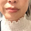 肌育注射（ジュベルックなど） / RF（高周波）たるみ治療 Wi Clinic （ウィ クリニック）心斎橋院 BEFORE サムネイル用
