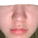 ピーリング（ニキビ・毛穴） / 光治療（フォトフェイシャルなど） / ピーリング（ハリ・ツヤ） DAILY SKIN CLINIC 新宿院 BEFORE サムネイル用