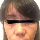 下まぶたたるみ取り / PRP皮膚再生療法 RDクリニック大阪 BEFORE サムネイル用
