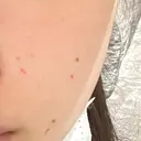 ほくろ・いぼ切除（肌） 美容皮膚科エルムクリニック 大阪院 BEFORE サムネイル用