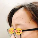 額を丸く / 脂肪注入（額） / 再生医療 / PRP皮膚再生療法 エートップ美容整形外科 BEFORE サムネイル用