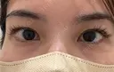 自然癒着法 eクリニック 那覇院 BEFORE サムネイル用