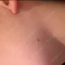 ほくろ・いぼ切除（肌） / ほくろ・いぼ除去レーザー（肌） Fellez Clinic【フェルズクリニック】 BEFORE サムネイル用