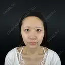 二重埋没 / ほくろ・いぼ切除（肌） / 上まぶたの脂肪取り / タレ目形成・グラマラスライン（切開） / 目元修正 / ボトックス（眉間） 藤・ナチュレ美容クリニック 銀座院 BEFORE サムネイル用