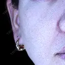 肌育注射（ジュベルックなど） Natural Skin Clinic 自由ヶ丘院 BEFORE サムネイル用