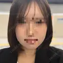 ボトックス（エラ・小顔） AYANAフィラーズクリニック 渋谷院 BEFORE サムネイル用