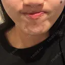 ボトックス（エラ・小顔） BISIN GINZA CLINIC BEFORE サムネイル用