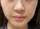 シミ取りレーザー / LDM・インテンスウルトラ Wi Clinic （ウィ クリニック）心斎橋院 BEFORE サムネイル用