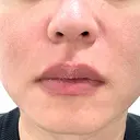 肌育注射（ジュベルックなど） / ニードルRF（ポテンツァなど） PureMe Skin Clinic（ピュアミースキンクリニック麻布） BEFORE サムネイル用