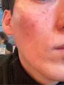 ピコレーザートーニング（美白・かんぱん） / ピコフラクショナルレーザー（毛穴・ニキビ跡） やさしい美容皮膚科・皮フ科　秋葉原院 BEFORE サムネイル用