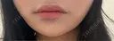 ヒアルロン酸注入（唇） Moon Beauty Clinic BEFORE サムネイル用