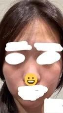 ピーリング（ニキビ・毛穴） EME CLINIC BEFORE サムネイル用