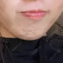 ボトックス（あご） BISIN GINZA CLINIC BEFORE サムネイル用