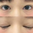 蒙古ひだ形成 / 目元修正 銀座高須クリニック BEFORE サムネイル用