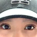 二重埋没 恵聖会クリニック 京橋院 BEFORE サムネイル用