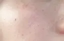 ピーリング（ニキビ・毛穴） / ルメッカ ルラ美容クリニック 大宮院 / ルラスキンクリニック 大宮院 BEFORE サムネイル用