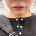 ヒアルロン酸注入（涙袋） / ヒアルロン酸注入（唇） PRO CLINIC プロクリニック 銀座院 BEFORE サムネイル用