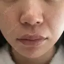 ヒアルロン酸注入（鼻翼基部） DMTC CLINIC 日本橋院 BEFORE サムネイル用