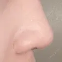 軟骨移植 / 鼻修正 / 鼻孔縁下降 / 鼻柱下降・鼻唇角形成（猫手術） ASTRA BEAUTY CLINIC BEFORE サムネイル用