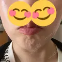 ボトックス（エラ・小顔） BISIN GINZA CLINIC BEFORE サムネイル用