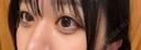 二重埋没 アリエル美容クリニック 郡山院 BEFORE サムネイル用