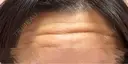 ボトックス（額） 神戸スイミー皮膚科美容外科 BEFORE サムネイル用