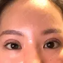 二重埋没 / ヒアルロン酸注入（唇） / ボトックス（口角） ルラ美容クリニック 名古屋栄院 / ルラスキンクリニック 名古屋栄院 BEFORE サムネイル用